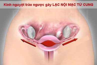 Bệnh lạc nội mạc tử cung - Phòng khám đa khoa y học quốc tế 