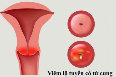 Bệnh phụ khoa và cách phòng tránh hiệu quả 