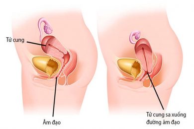 Bệnh sa tử cung - Phòng khám đa khoa y học quốc tế 