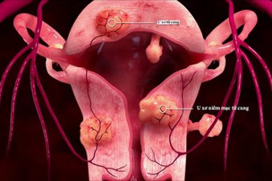 Bệnh u xơ tử cung - Phòng khám đa khoa y học quốc tế 