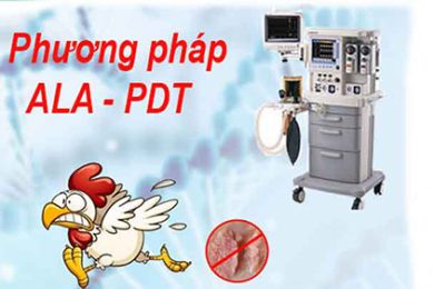 Công nghệ điều trị sùi mào gà từ phương pháp ALA -PDT 