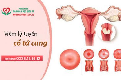 Viêm lộ tuyến cổ tử cung - Phòng khám đa khoa y học quốc tế 