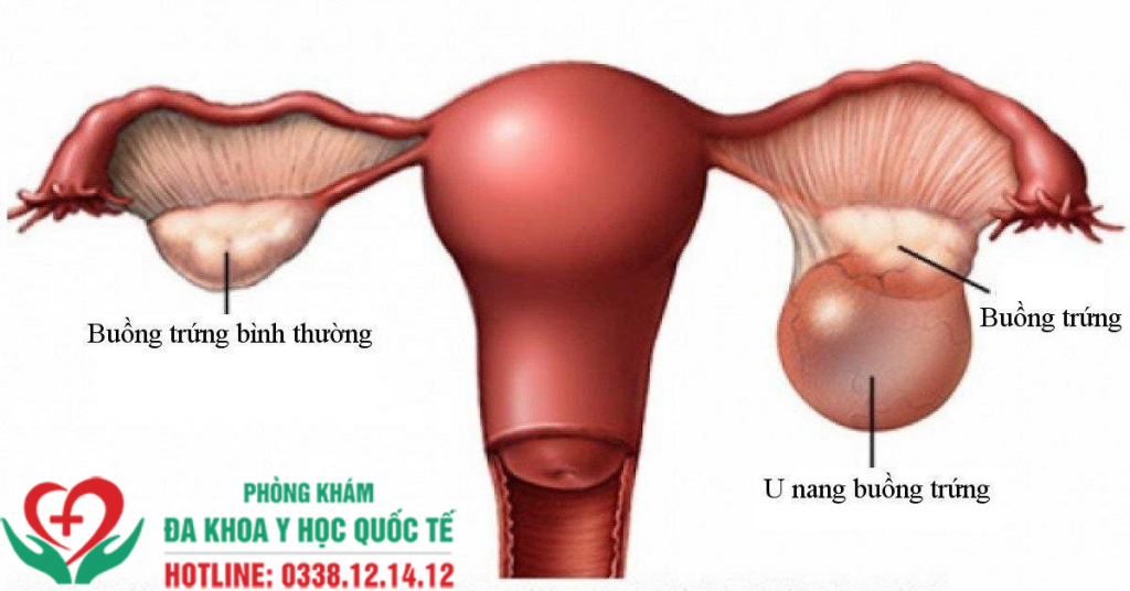 U NANG BUỒNG TRỨNG LÀ GÌ?