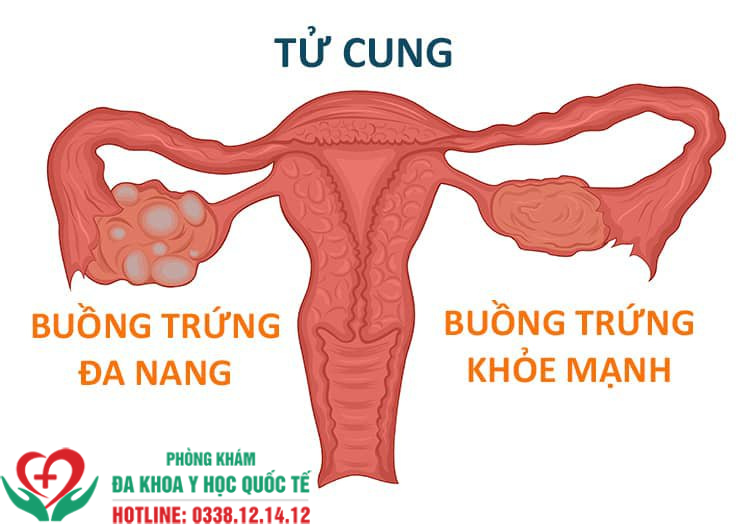 Buồng trứng đa nang là bệnh gì?