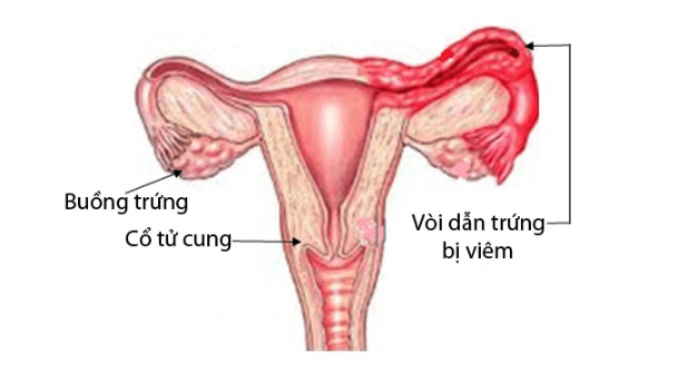 Viêm ống dẫn trứng là bệnh gì?