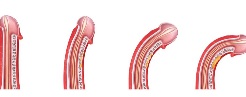 Nguyên nhân khiến dương vật bị cong