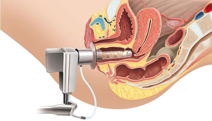 THU HẸP VÀ TRẺ HOÁ VÙNG KÍN BẰNG LASER LÀ GÌ?